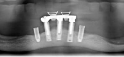 Implant gydjl3 - Eugenol