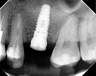 Implant juillet 2010 cnmkmg - Eugenol