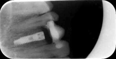 Implant mzjsmh - Eugenol