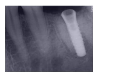 Implant x1 oudtrc - Eugenol