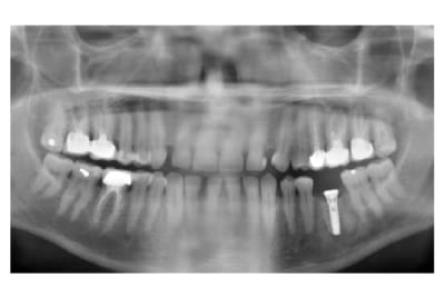 Implant x jkbepn - Eugenol