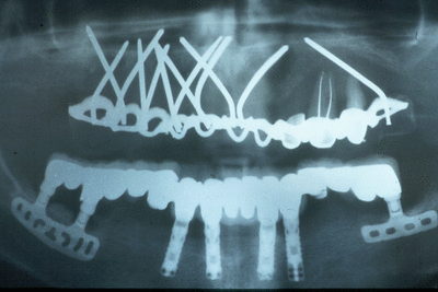 Implantmultiple qr0b5y - Eugenol