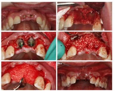 Implants 11 21 kbjc3r - Eugenol