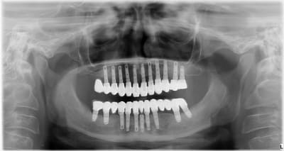 Implants lex rx95tz - Eugenol