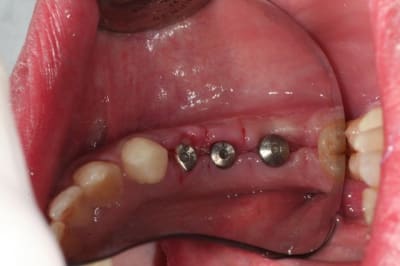 Implants sans fil ot1vm0 - Eugenol
