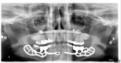 Implants sousp riost s bilat rales la4whg - Eugenol