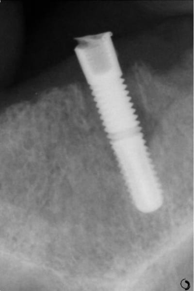 Implantx3 lozmpc - Eugenol