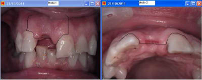 Incision tt0gtm - Eugenol