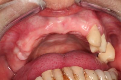 Initial maxillaire md6ecc - Eugenol