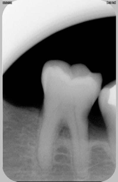 Interradiculaire 2 u7i5kk - Eugenol