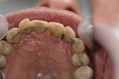 Jonc splint sw7lxt - Eugenol