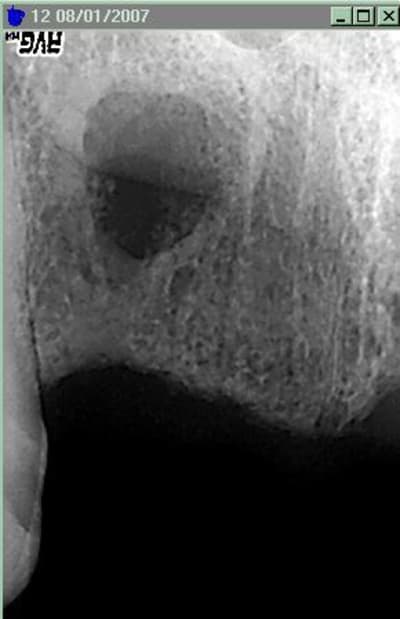 Kyste  isolé ijtbzx - Eugenol