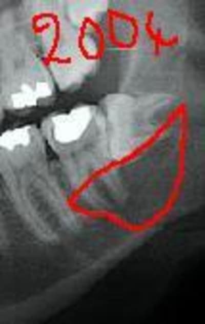 Kystepaxv1 v2jehw - Eugenol