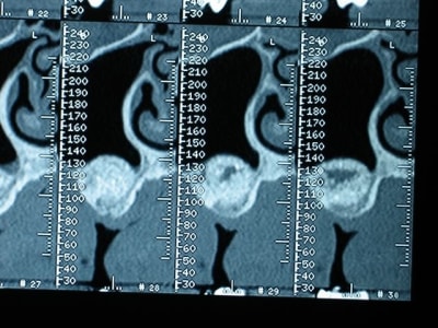 Lacune sinus 2 tmvbq0 - Eugenol
