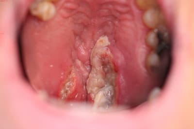 Lesion muqueuse2 jvd16d - Eugenol