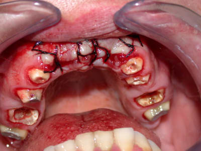 Maxillaire0 fc3smt - Eugenol