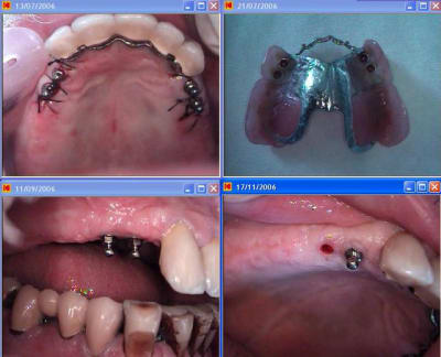 Mini implants t1sqx8 - Eugenol