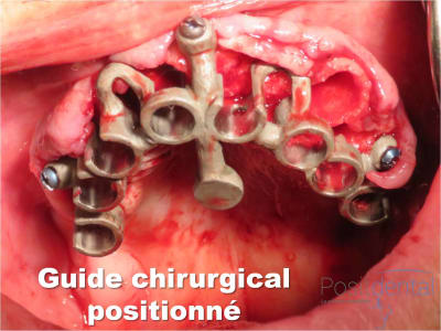 Mise en charge immédiate   implant tov  positdental 009 s6neoz - Eugenol