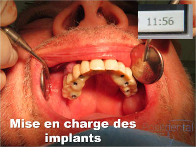 Mise en charge immédiate   implant tov  positdental 015 lcifjd - Eugenol