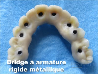 Mise en charge immédiate   implant tov  positdental 021 snafmj - Eugenol