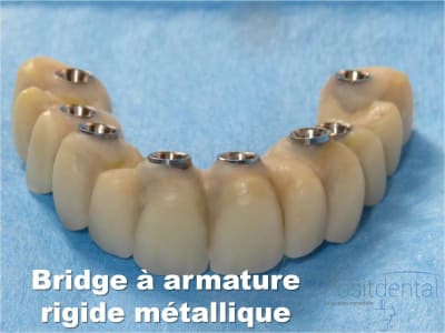 Mise en charge immédiate   implant tov  positdental 023 dhtpn2 - Eugenol