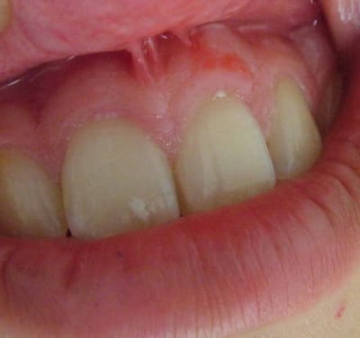 Mo2 pctaik - Eugenol