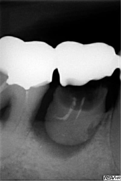 Molaire omg eptc66 - Eugenol