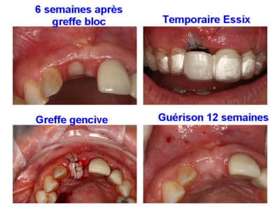 Montage ptlhxi - Eugenol