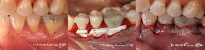 Multiple modified caf   mucograft v7k3b0 - Eugenol