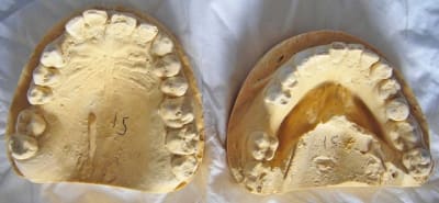 Occlusal fc0ktj - Eugenol