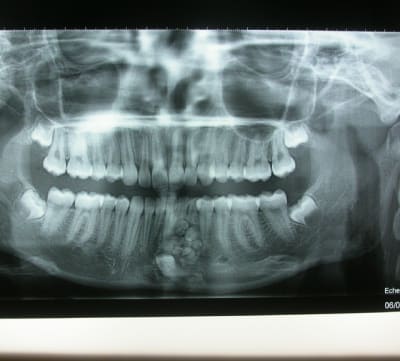 Odontome m5s6od - Eugenol