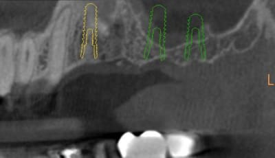 Opercalisation 1 xe88uv - Eugenol