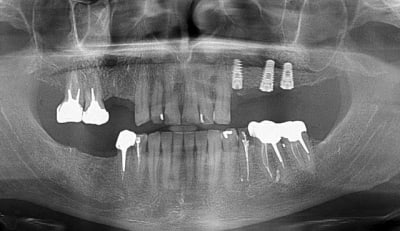 Opercalisation 2 ijzzdw - Eugenol