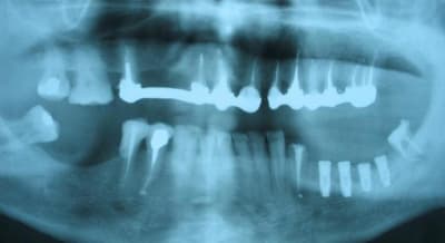 Pano imlant post op vhqz1u - Eugenol