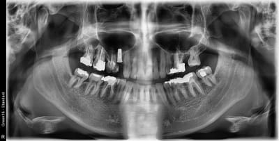 Pano implant mystere o9ilun - Eugenol