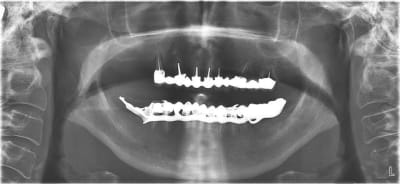 Pano initiale rxxmgx - Eugenol