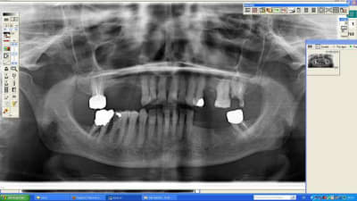 Patiente vama fiveqp - Eugenol