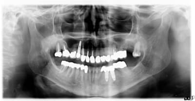 Post op  1  osgswu - Eugenol