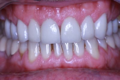 Post op facettes 001 vrbla7 - Eugenol
