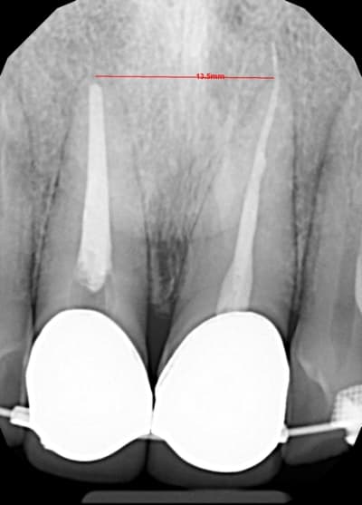 Post op tpqpau - Eugenol