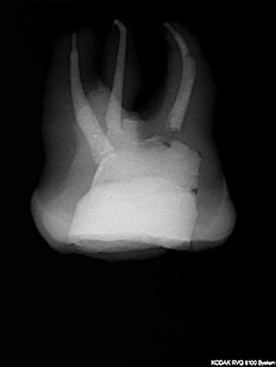 Post extraction 2007 odxyv7 - Eugenol