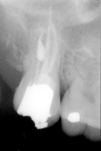 Post op 2002 ku9crh - Eugenol