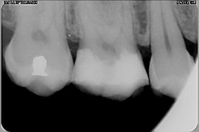 Post op 3 copy yxqhog - Eugenol