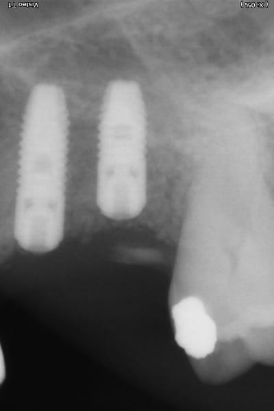 Post op rvg 3 olylyc - Eugenol