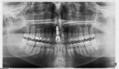 Postop x2dmol - Eugenol