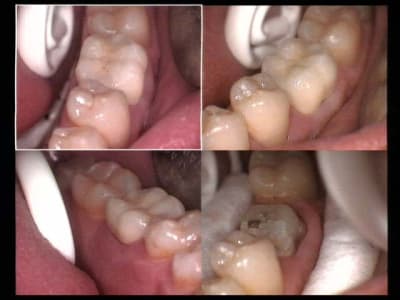 Procera bidet 36 t5csu9 - Eugenol