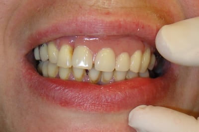 Provisoire 5 dents antérieures 2 dgliub - Eugenol