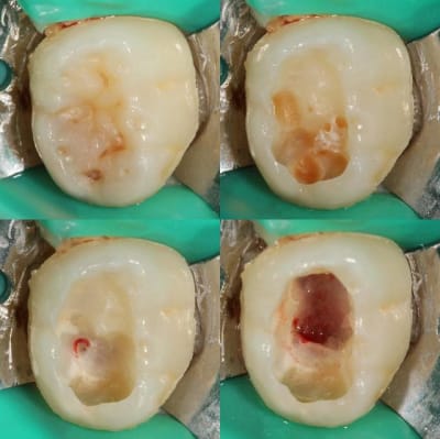 Pulpo1 epzdx0 - Eugenol