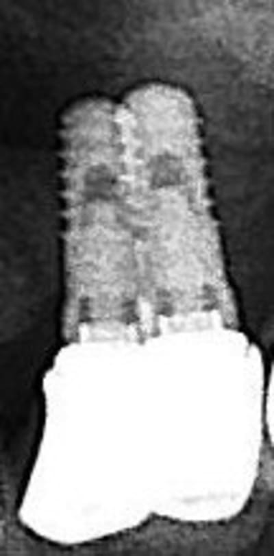 Quels implants   copie t1bm44 - Eugenol