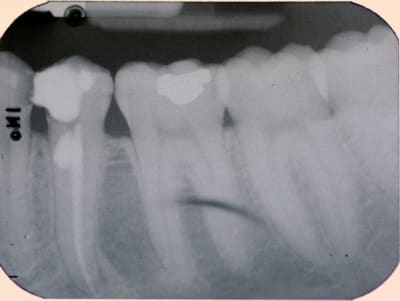 Résorption powb0g - Eugenol